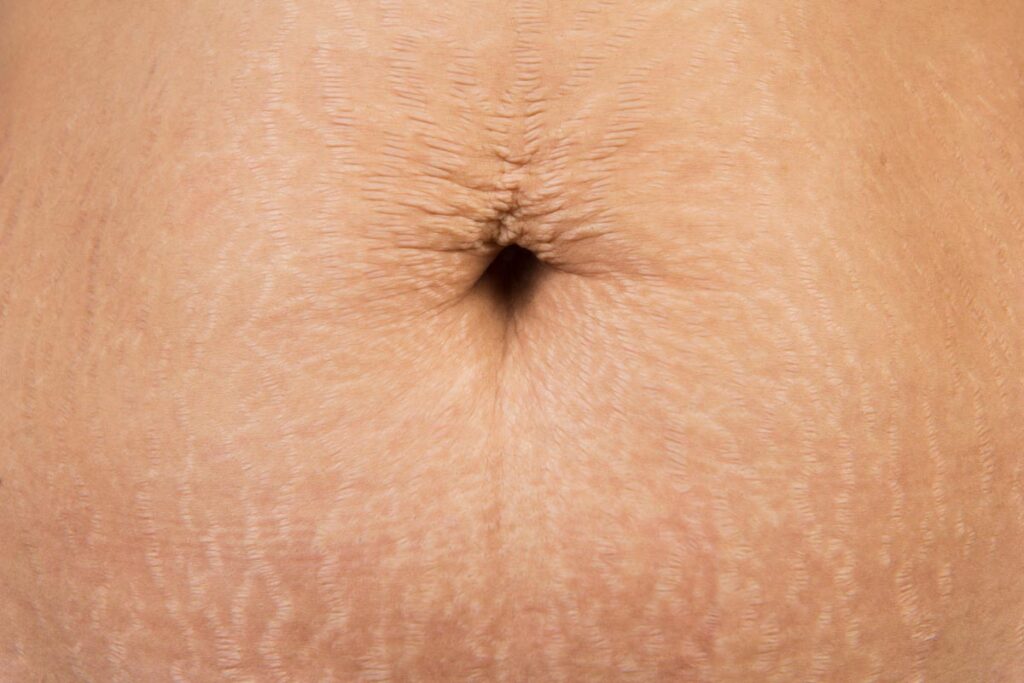 postpartum stretch marks