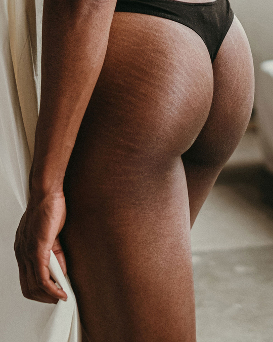 The Truth About Stretch Marks